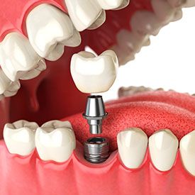 dental implant being placed in the lower jaw 