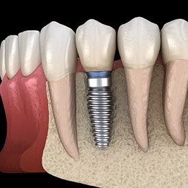 dental implant fusing with the jawbone 