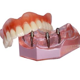 Smiling man with All-on-4 denture
