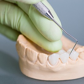 A dental bridge near an educational model of gums with implants