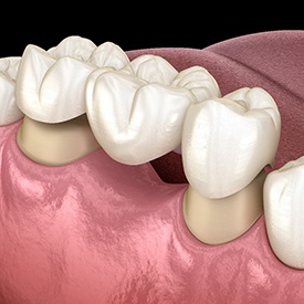 A dental technician working on a dental bridge