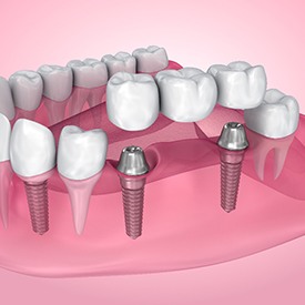 A 3D illustration of a traditional dental bridge