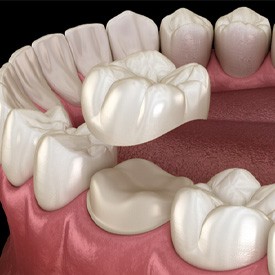 3D render of a dental crown