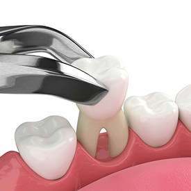 Illustration of tooth being extracted