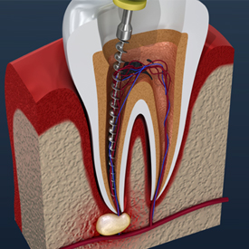 3D model of a root canal 