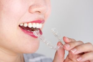 using invisalign