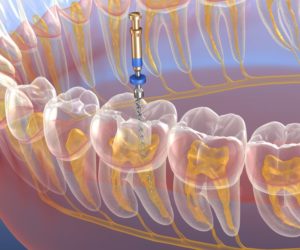 root canal 3d illustration 