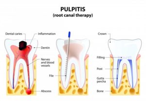 root canal illustration 