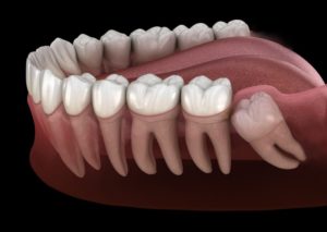 a computer-generated diagram of an impacted wisdom tooth