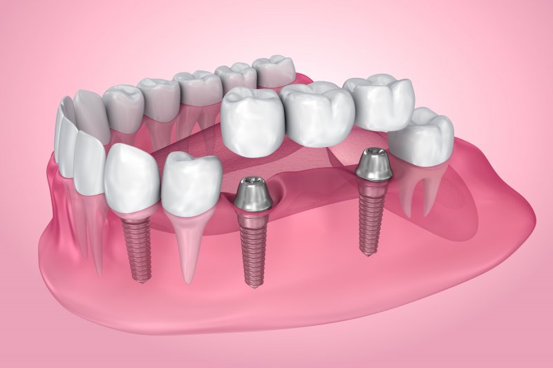 Exploded illustration of dental implants with bridge and crown