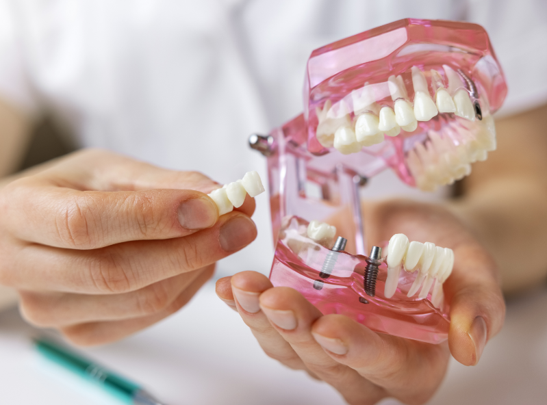 Dental implant model